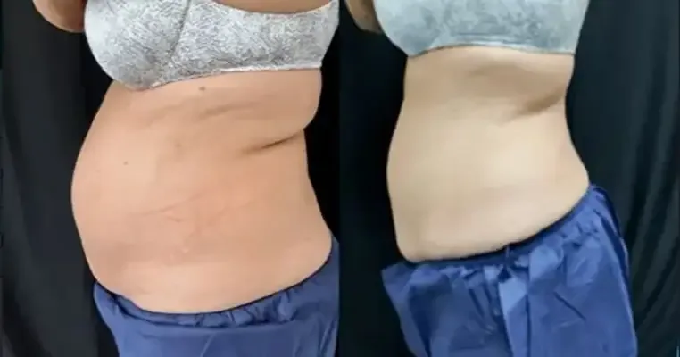 CoolSculpting body contouring at Kenzi MedSpa in Naples