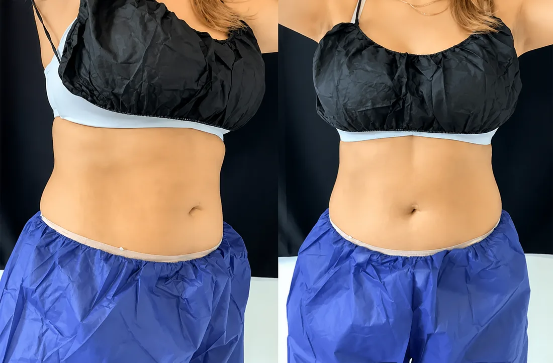 Patient during a physician-led body contouring session at Kenzi MedSpa