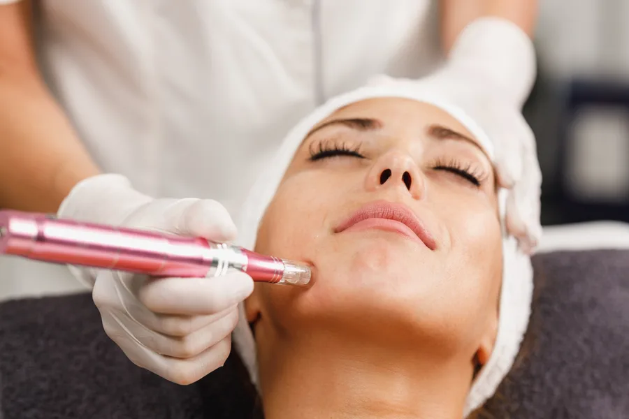 Radiofrequency energy delivered beneath the skin's surface through microneedles