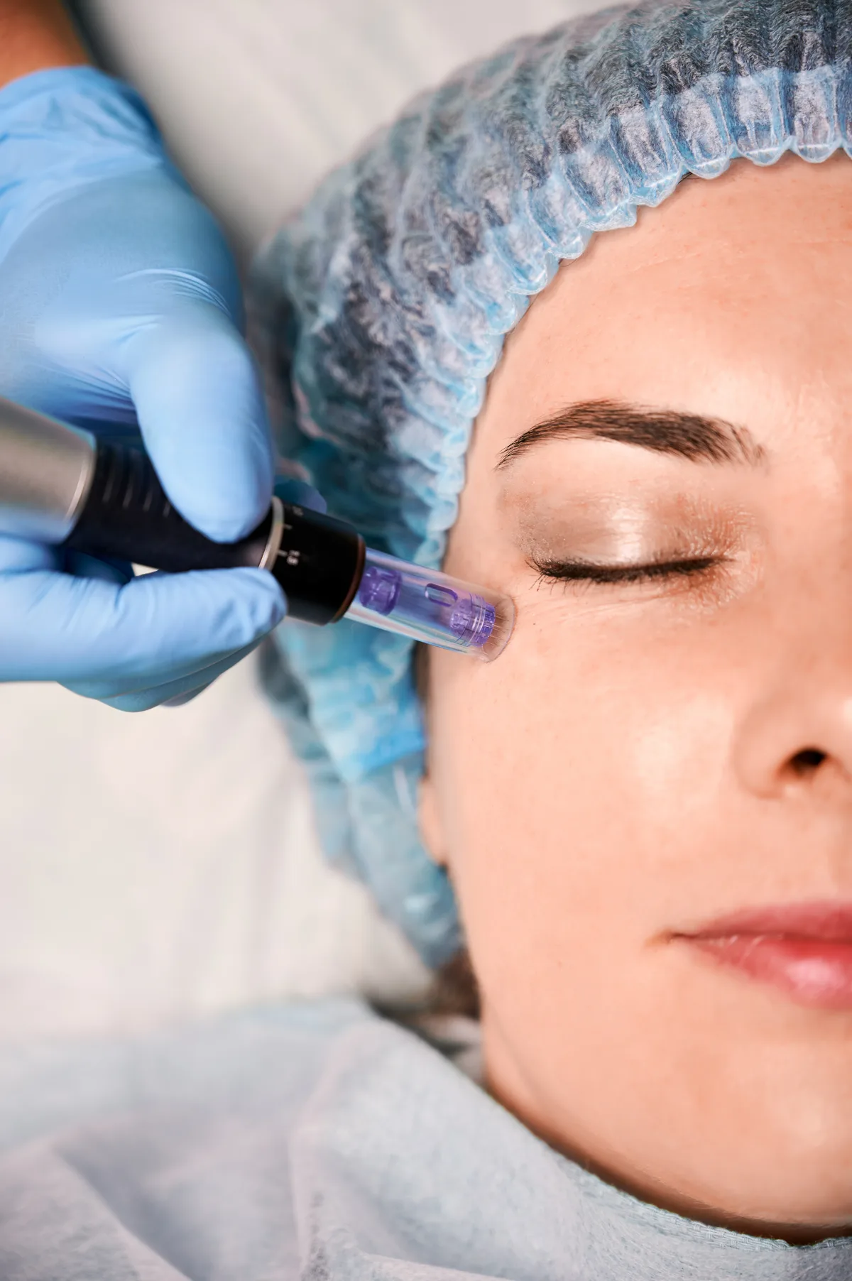 Fractional RF Microneedling treatment at Kenzi Medical & Aesthetics Group in Naples