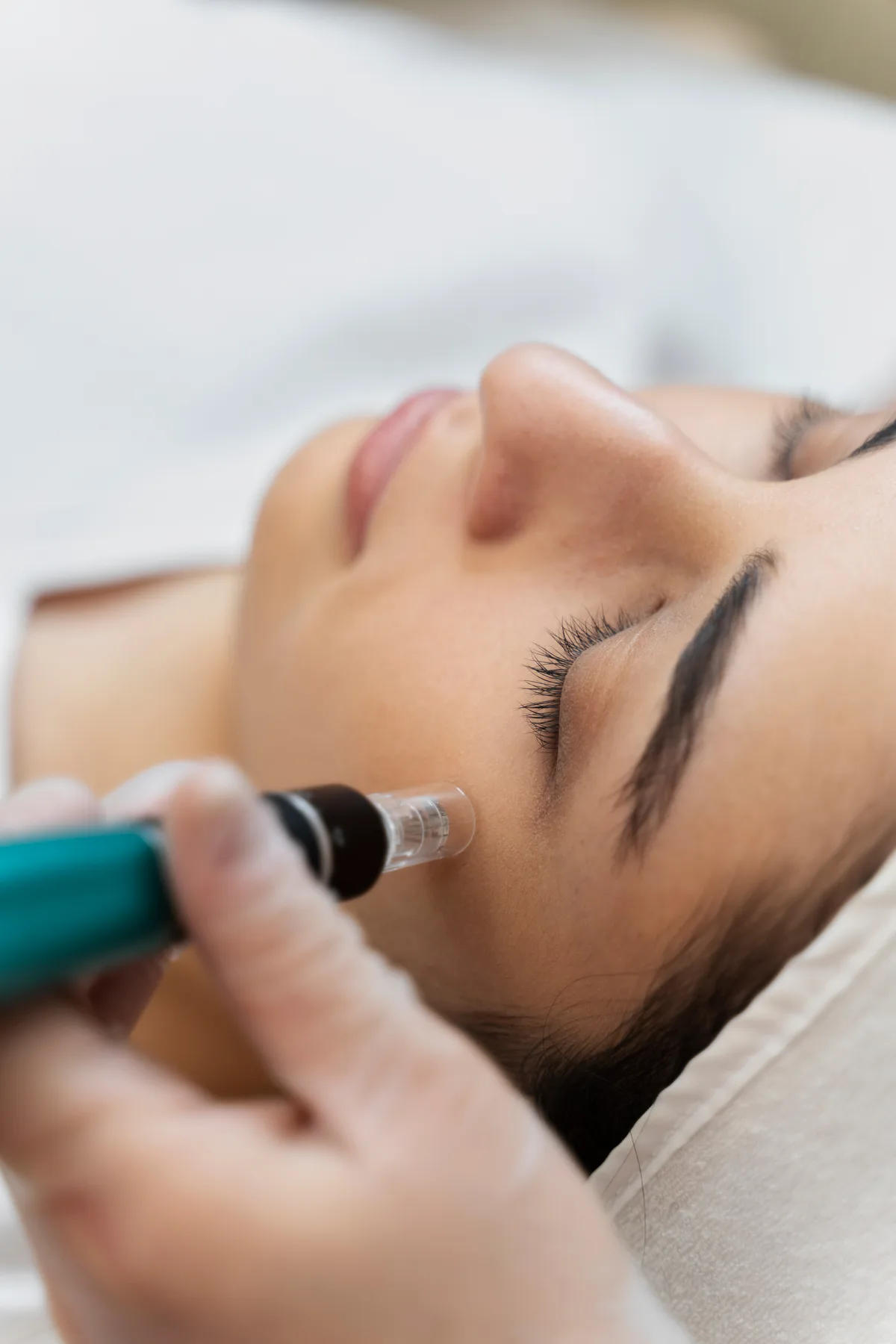 Microneedling treatment at Kenzi MedSpa