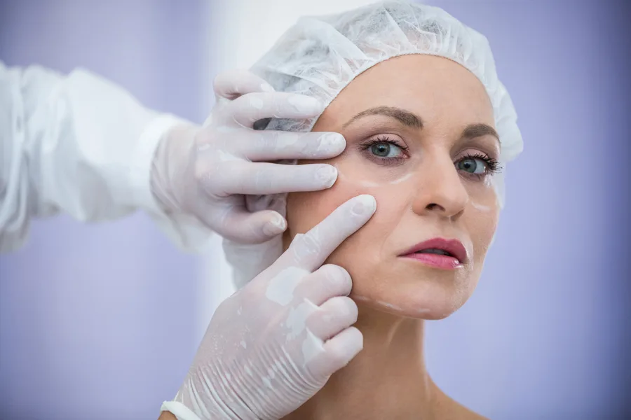 Clinician placing fine PDO threads beneath the skin along a patient's jawline