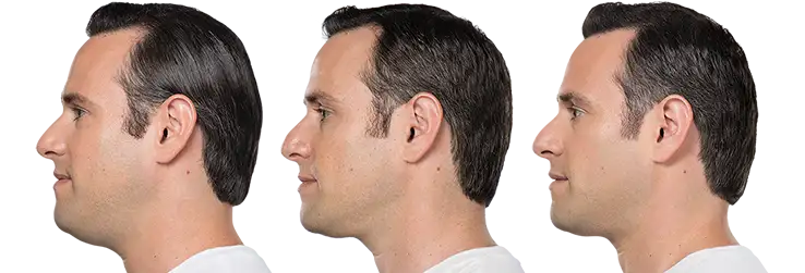 Male Before After Kybella